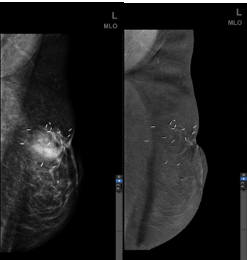 乳腺机是什么乳腺病患者的福音！全球高端能谱乳腺机在我院投入使用_https://www.jmylbn.com_新闻资讯_第8张