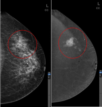 乳腺机是什么乳腺病患者的福音！全球高端能谱乳腺机在我院投入使用_https://www.jmylbn.com_新闻资讯_第7张