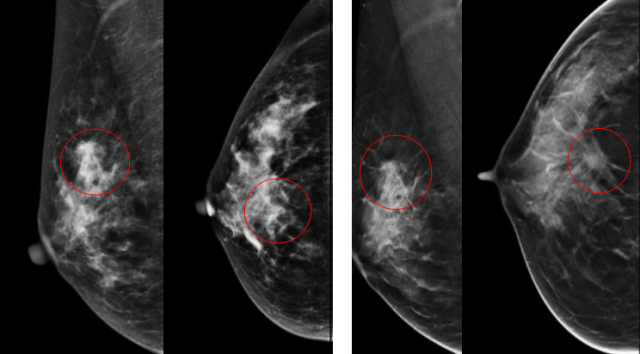 乳腺机是什么乳腺病患者的福音！全球高端能谱乳腺机在我院投入使用_https://www.jmylbn.com_新闻资讯_第6张