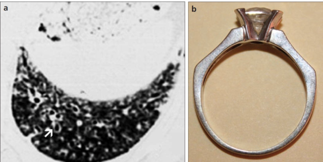 ct片子怎么印看到印戒征，只想到支气管扩张症？还可能是这些病！-上海聚慕医疗器械有限公司