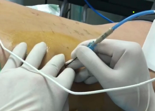 射频什么科痛痛痛……腹痛两年,住院四次,男子差点被当成精神病……_新闻资讯_第7张_活检穿刺产品网 射频什么科痛痛痛……腹痛两年,住院四次,男子差点被当成精神病……_https://www.jmylbn.com_新闻资讯_第7张