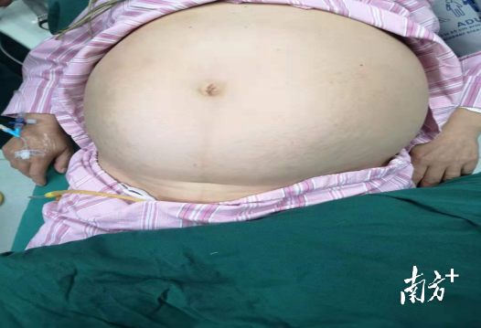 彩超及核磁共振提示，罗女士腹腔内长有巨大包块