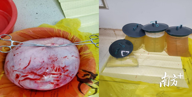 卵巢肿瘤大小为40 X 36 X 17cm，吸出囊液约为9.1L