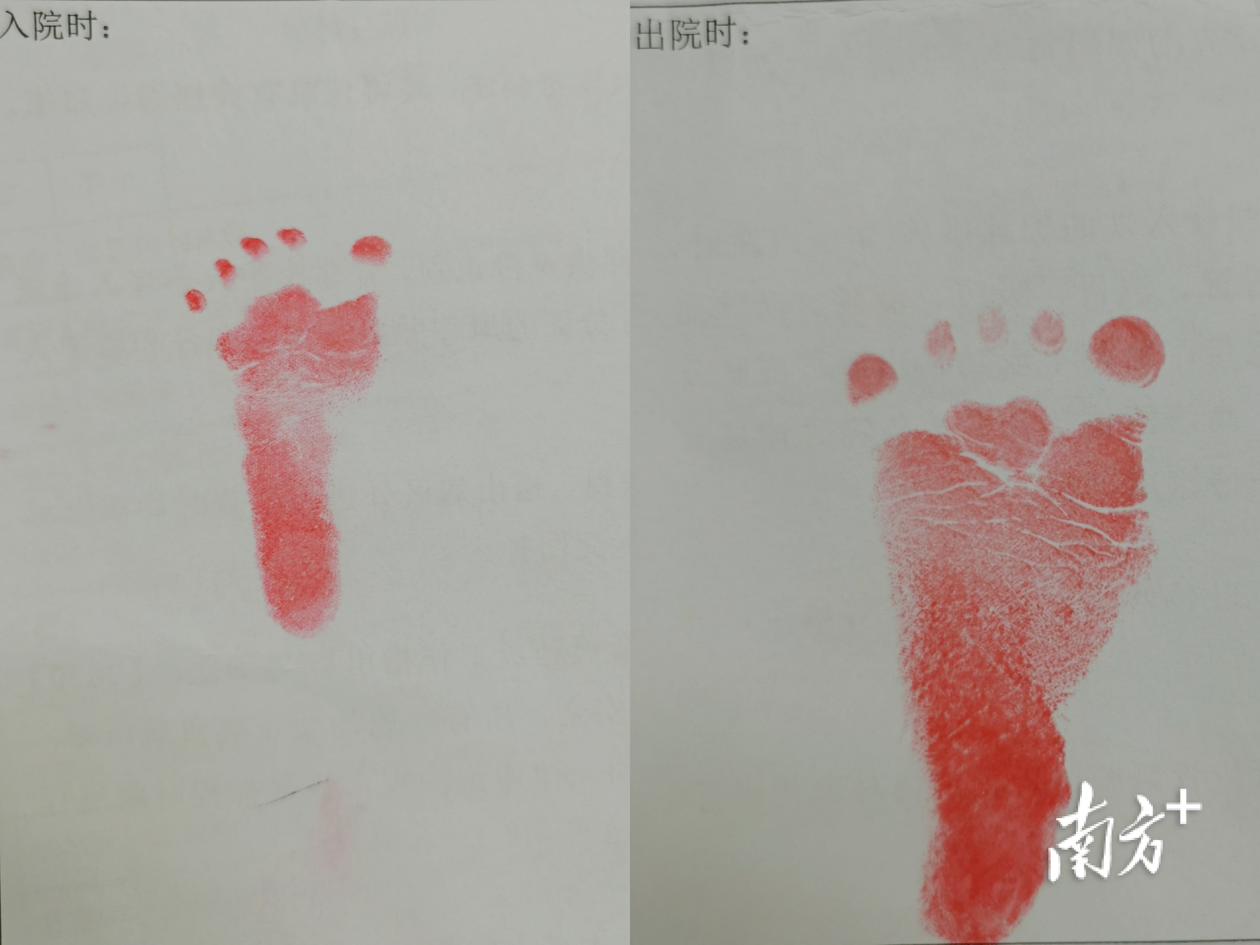 入院时和出院时的小脚丫对比。