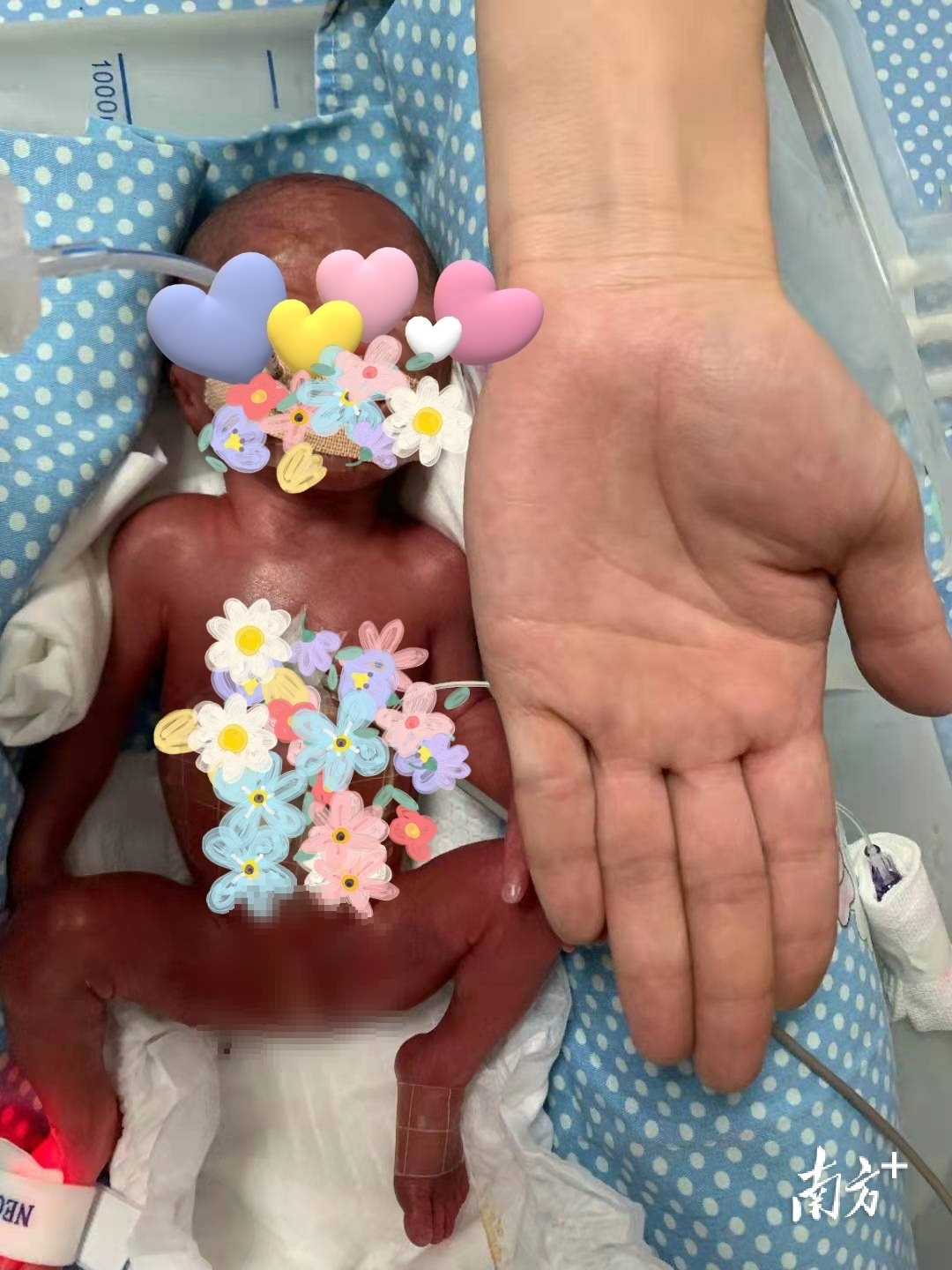 出生时仅670克,巴掌大小。