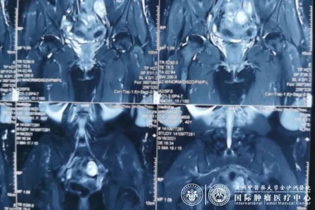 怎么用医疗灌注子宫内膜癌患者真实案例:DSA可视动脉介入灌注治疗治疗后效果!_新闻资讯_第3张_活检穿刺产品网 怎么用医疗灌注子宫内膜癌患者真实案例:DSA可视动脉介入灌注治疗治疗后效果!_https://www.jmylbn.com_新闻资讯_第3张