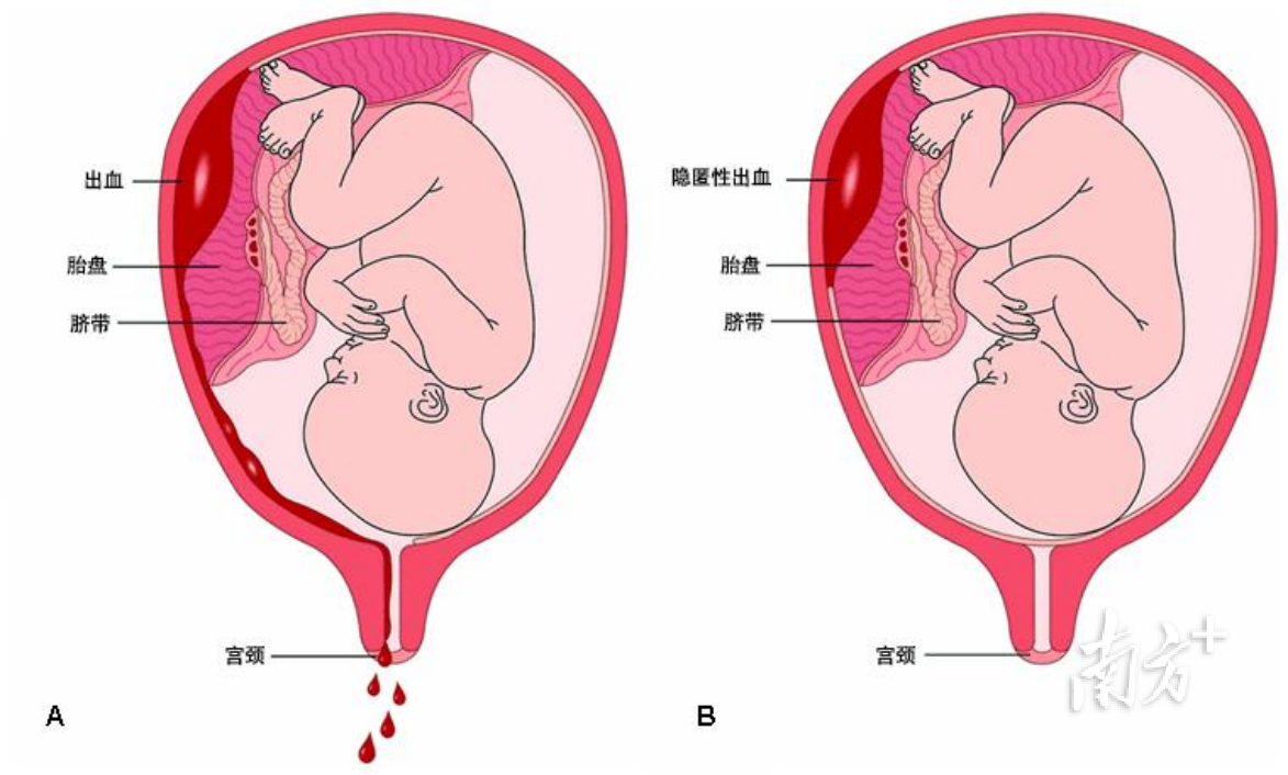 惊险!产妇突发胎盘早剥,滨海湾中心医院产科团队8分钟化险为夷(资料图)