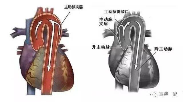 割动脉要用什么刀>>" id="articleTitle" data-columnid="30310">胸背部撕裂样或刀割样疼痛?小心主动脉藏着“定时炸弹”-上海聚慕医疗器械有限公司