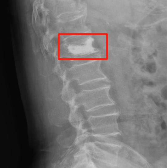 什么是牵引床年纪大了,腰酸背痛、个子变矮?万万没想到是这个原因……_新闻资讯_第4张_活检穿刺产品网 什么是牵引床年纪大了,腰酸背痛、个子变矮?万万没想到是这个原因……_https://www.jmylbn.com_新闻资讯_第4张