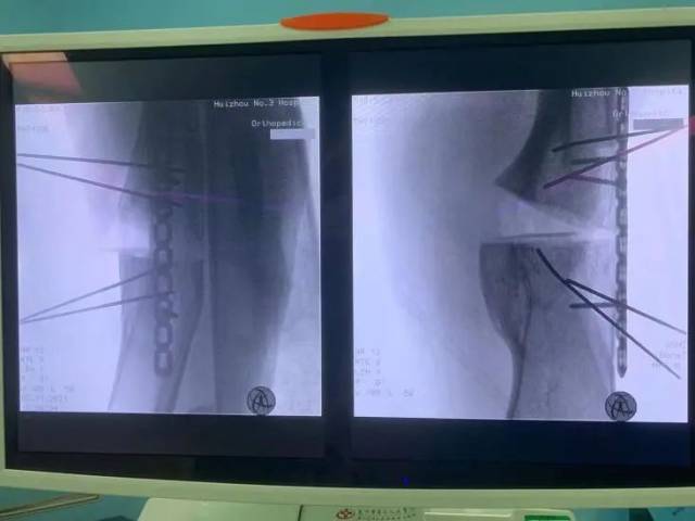 为什么骨科用摆锯3D打印技术辅助下的下肢矫形手术在惠州三院骨科医学中心成功开展!_新闻资讯_第6张_活检穿刺产品网 为什么骨科用摆锯3D打印技术辅助下的下肢矫形手术在惠州三院骨科医学中心成功开展!_https://www.jmylbn.com_新闻资讯_第6张
