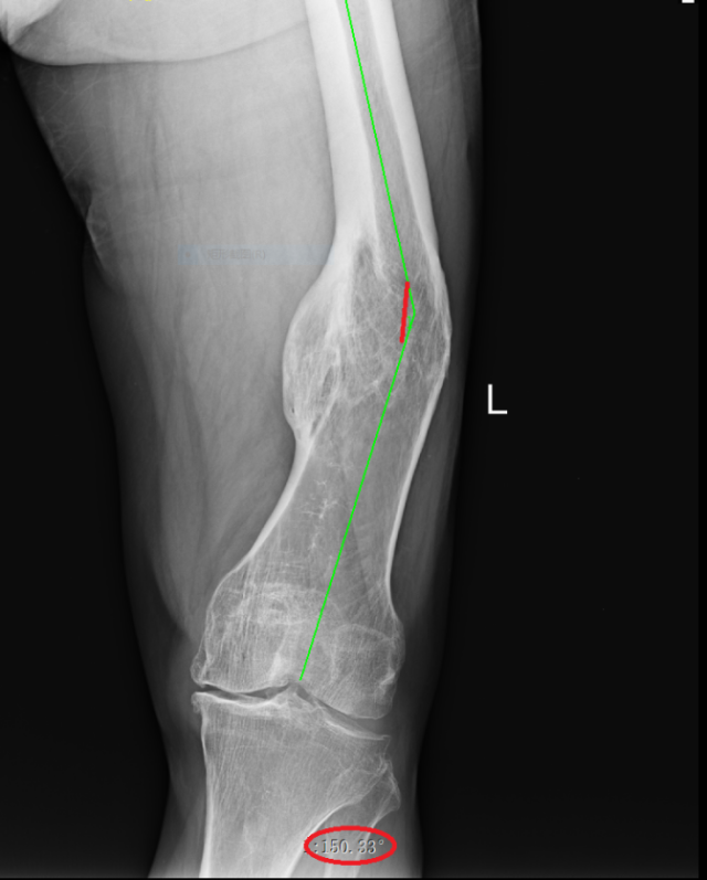 为什么骨科用摆锯3D打印技术辅助下的下肢矫形手术在惠州三院骨科医学中心成功开展!_新闻资讯_第4张_活检穿刺产品网 为什么骨科用摆锯3D打印技术辅助下的下肢矫形手术在惠州三院骨科医学中心成功开展!_https://www.jmylbn.com_新闻资讯_第4张