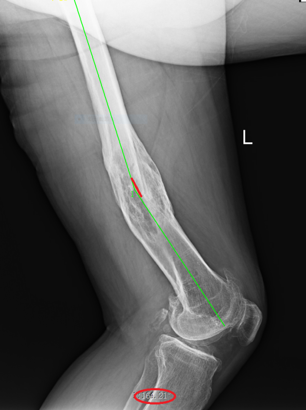 为什么骨科用摆锯3D打印技术辅助下的下肢矫形手术在惠州三院骨科医学中心成功开展!_新闻资讯_第5张_活检穿刺产品网 为什么骨科用摆锯3D打印技术辅助下的下肢矫形手术在惠州三院骨科医学中心成功开展!_https://www.jmylbn.com_新闻资讯_第5张