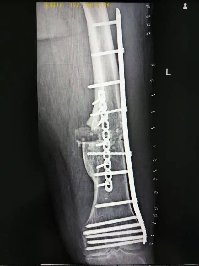 为什么骨科用摆锯3D打印技术辅助下的下肢矫形手术在惠州三院骨科医学中心成功开展!_新闻资讯_第7张_活检穿刺产品网 为什么骨科用摆锯3D打印技术辅助下的下肢矫形手术在惠州三院骨科医学中心成功开展!_https://www.jmylbn.com_新闻资讯_第7张