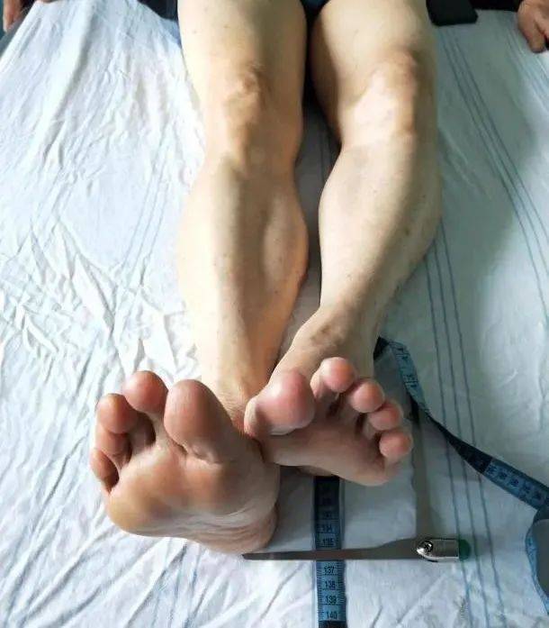 为什么骨科用摆锯3D打印技术辅助下的下肢矫形手术在惠州三院骨科医学中心成功开展!_新闻资讯_第2张_活检穿刺产品网 为什么骨科用摆锯3D打印技术辅助下的下肢矫形手术在惠州三院骨科医学中心成功开展!_https://www.jmylbn.com_新闻资讯_第2张