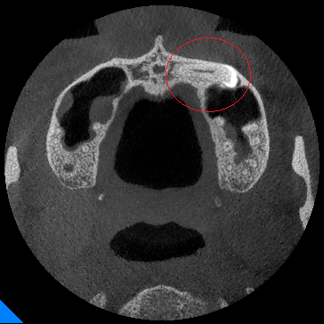 X光拍片为什么要等看牙为什么要拍片?对人体的辐射大吗?_新闻资讯_第20张_活检穿刺产品网 X光拍片为什么要等看牙为什么要拍片?对人体的辐射大吗?_https://www.jmylbn.com_新闻资讯_第20张