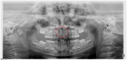 X光拍片为什么要等看牙为什么要拍片?对人体的辐射大吗?_新闻资讯_第14张_活检穿刺产品网 X光拍片为什么要等看牙为什么要拍片?对人体的辐射大吗?_https://www.jmylbn.com_新闻资讯_第14张