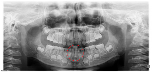 X光拍片为什么要等看牙为什么要拍片?对人体的辐射大吗?_新闻资讯_第13张_活检穿刺产品网 X光拍片为什么要等看牙为什么要拍片?对人体的辐射大吗?_https://www.jmylbn.com_新闻资讯_第13张