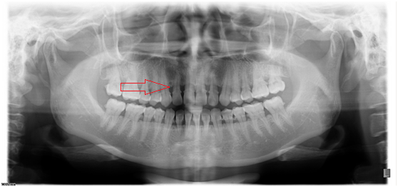 X光拍片为什么要等看牙为什么要拍片?对人体的辐射大吗?_新闻资讯_第16张_活检穿刺产品网 X光拍片为什么要等看牙为什么要拍片?对人体的辐射大吗?_https://www.jmylbn.com_新闻资讯_第16张