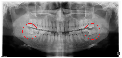 X光拍片为什么要等看牙为什么要拍片?对人体的辐射大吗?_新闻资讯_第15张_活检穿刺产品网 X光拍片为什么要等看牙为什么要拍片?对人体的辐射大吗?_https://www.jmylbn.com_新闻资讯_第15张
