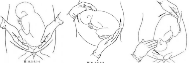 臀位外倒转术示意图 王晓怡主任介绍，臀位外倒转术是目前有循证医学证据证实的纠正臀位的有效方法