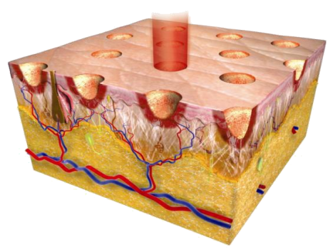 什么是妇科激光外阴瘙痒、阴道松弛、尿失禁……二氧化碳点阵激光助您提高“性”福指数_新闻资讯_第1张_活检穿刺产品网 什么是妇科激光外阴瘙痒、阴道松弛、尿失禁……二氧化碳点阵激光助您提高“性”福指数_https://www.jmylbn.com_新闻资讯_第1张