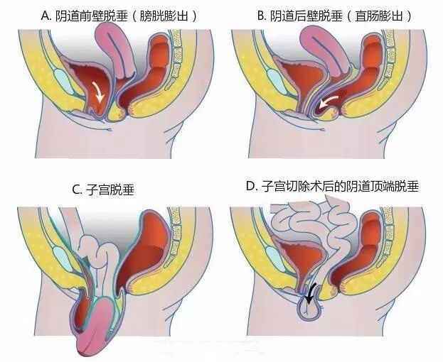 性功能康复治疗是什么它是威胁女性健康最常见的慢性疾病之一!莫担心,有办法!_新闻资讯_第2张_活检穿刺产品网 性功能康复治疗是什么它是威胁女性健康最常见的慢性疾病之一!莫担心,有办法!_https://www.jmylbn.com_新闻资讯_第2张