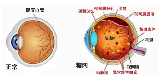 dr医疗怎么下降糖尿病逆转治疗3个月,视力大幅度提升,免费视网膜病变筛查开始啦!_新闻资讯_第4张_活检穿刺产品网 dr医疗怎么下降糖尿病逆转治疗3个月,视力大幅度提升,免费视网膜病变筛查开始啦!_https://www.jmylbn.com_新闻资讯_第4张