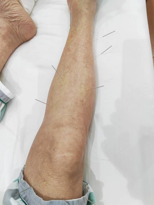 经颅磁治疗怎么样经颅重复磁刺激联合神经修复治疗脑梗死偏瘫效果明显_https://www.jmylbn.com_新闻资讯_第2张