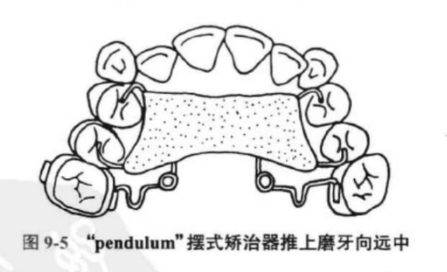 什么是医用高值耗材推磨牙向后的病例，一定要选择隐形矫正吗？_https://www.jmylbn.com_新闻资讯_第3张