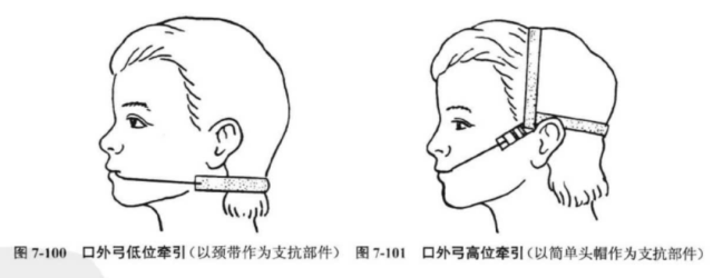 什么是医用高值耗材推磨牙向后的病例，一定要选择隐形矫正吗？_https://www.jmylbn.com_新闻资讯_第2张