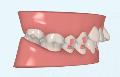 什么是医用高值耗材推磨牙向后的病例，一定要选择隐形矫正吗？_https://www.jmylbn.com_新闻资讯_第1张