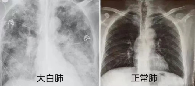 全麻后为什么送icu“阳康”后隆鼻结果进了ICU？何时能做医美？专家提醒了_https://www.jmylbn.com_新闻资讯_第3张