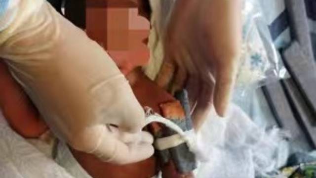 压舌板变“特制夹板”！广州援非医生巧手救治非洲骨折新生儿