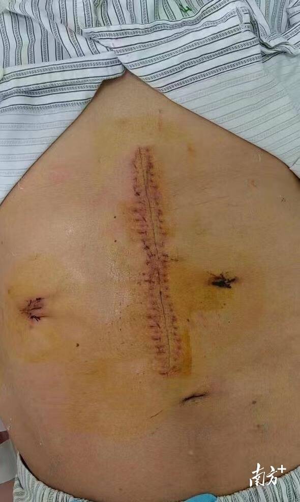 腹腔镜辅助下全肝移植术手术伤口小，创伤小且更为美观。 