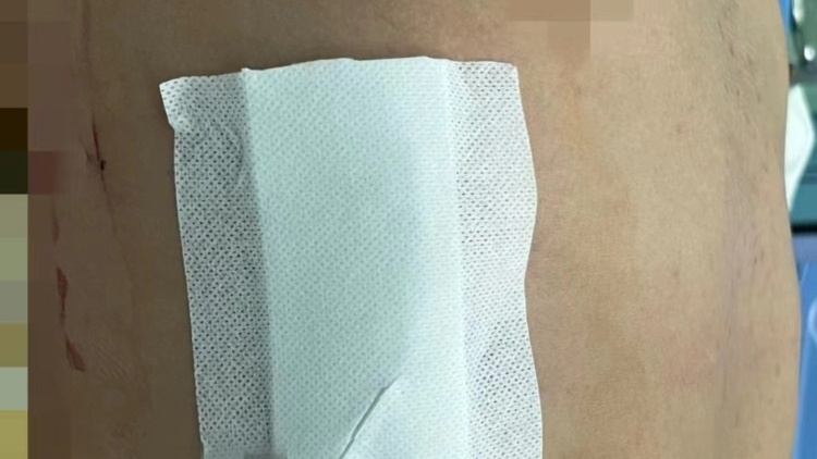 身高196厘米小伙漏斗胸压迫心脏，广州专家微创手术成功矫正