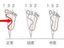 网购矫形鞋垫有风险，扁平足穿2月变外翻足
