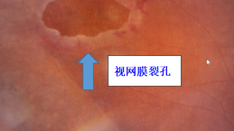 眼前突现大量“飞蚊”，警惕视网膜裂孔！