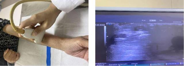 超声显示内瘘血栓形成，血栓直径最大约10毫米。