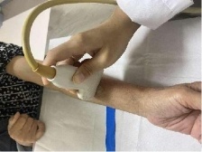 阿婆血透“生命线”堵塞，溶栓+球囊扩张1小时复通