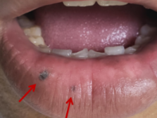 知名歌手因黑色素瘤去世，口腔里长这种黑斑也要当心！