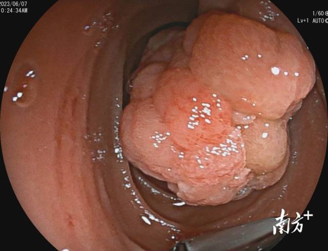 十二指肠乳头腺瘤几乎占据整个肠腔。  受访者供图