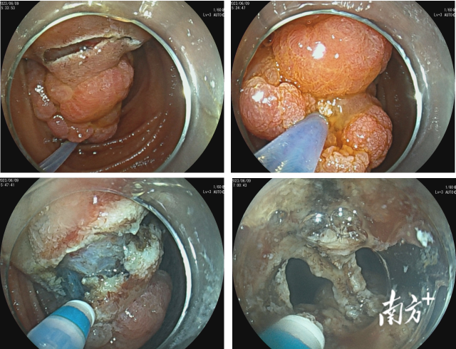 ESD术中。  受访者供图