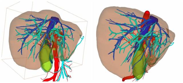 3D重建清晰展示患者肝胆周围血管关系。  受访者供图