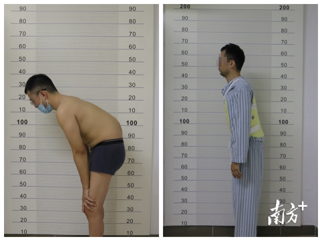 术前术后对比。