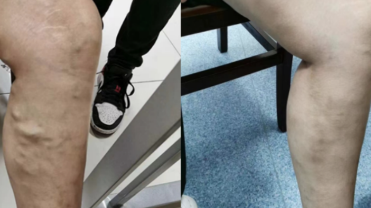 @这几种人群，快看看你有没有“蚯蚓腿”