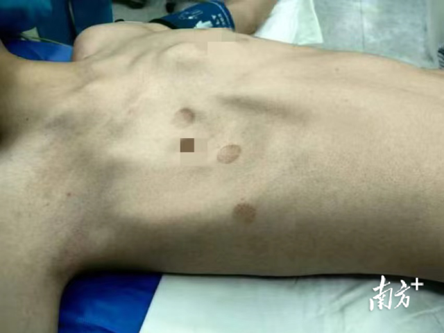 小宇的Poland综合征表现为右胸廓塌陷。  