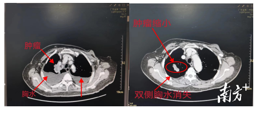 肺癌靶向治疗效果。