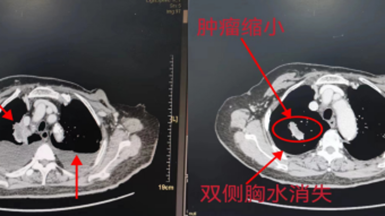 关于靶向治疗，你需要了解这几点!