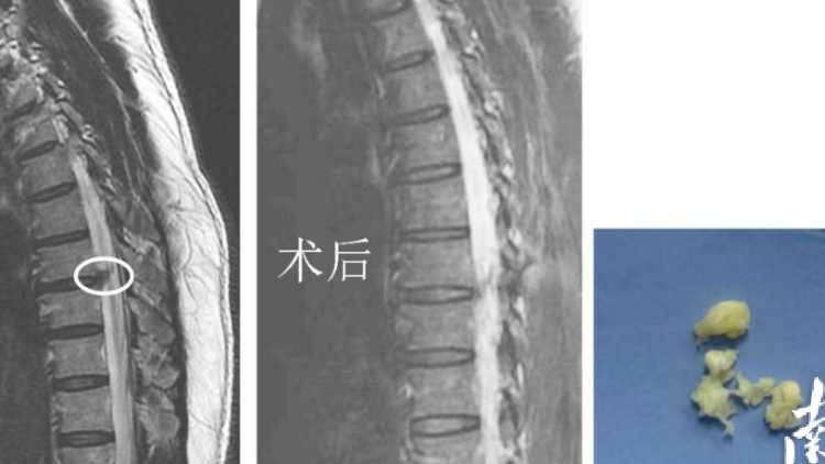 49岁男子反复胸痛 竟是胸椎间盘突出