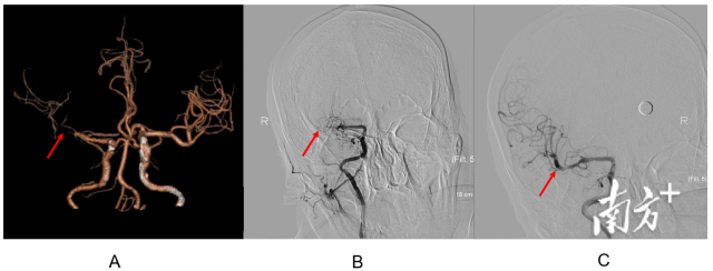 头颈部CTA和脑血管造影结果提示冯先生右侧大脑中动脉次全闭塞（图A和B箭头处），经过介入取栓、植入支架后，血管再通（图C箭头处）。  